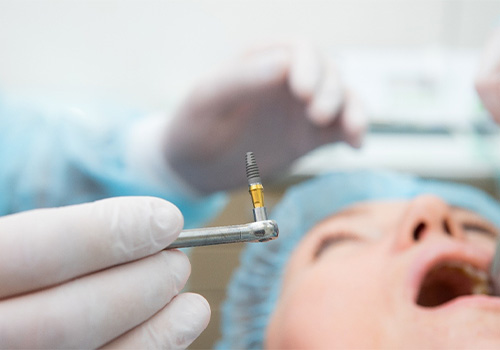 A dental implant being handled by an oral surgeon