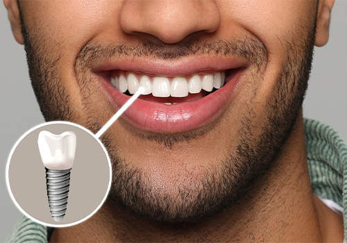An image highlighting a smiling man’s dental implant