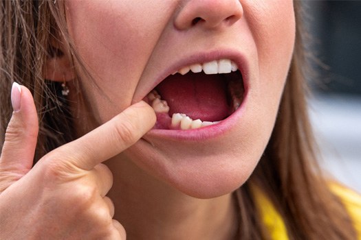 Closeup of a woman missing a tooth