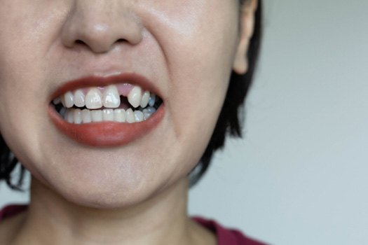 A woman with a missing tooth near River Oaks