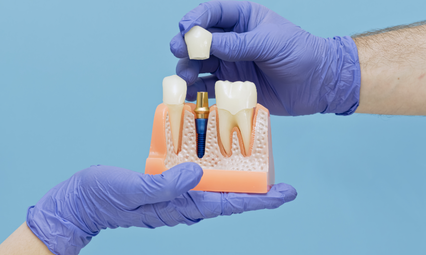 Dental implant model